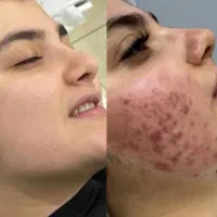 با جوش هات برای همیشه خداحافظی کن