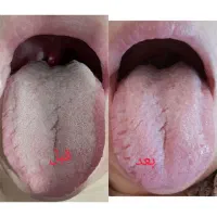 تشخیص بیماری از طریق عکس زبان