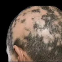 دیگه با ریزش موهات خداحافظی کن|آرایشی، بهداشتی، درمانی|کرج, عظیمیه|دیوار