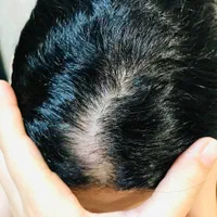 اسکراب اسکالپ موی سر(درمان)