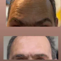 آف تزریق ژل وبوتاکس ومزوژل جوانساز|خدمات آرایشگری و زیبایی|آمل, |دیوار