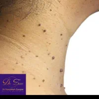 برداشت خال و زگیل *فقط 100* ویزیت رایگان