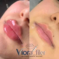 تزریق ژل سی سی ۴۰۰|خدمات آرایشگری و زیبایی|رباط‌کریم, نصیرشهر|دیوار