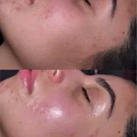 فیشیال،پاکسازی،درما پلنینگ|خدمات آرایشگری و زیبایی|بیرجند, |دیوار