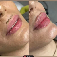 پاک کردن تتو بلفاروپلاستی لیپو غبغب در شهرری|خدمات آرایشگری و زیبایی|باقرشهر, |دیوار