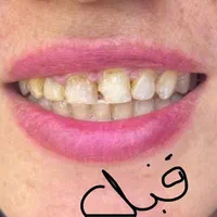 کامپوزیت دندادن