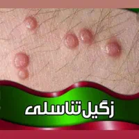 برداشتن زگیل تناسلی با قیمت پایین|خدمات آرایشگری و زیبایی|محمدیه-قزوین, |دیوار