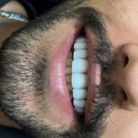 تخفیفات کامپوزیت زیبایی ونیر