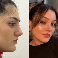 عمل بینی بدون بازگشت|خدمات آرایشگری و زیبایی|تهران, قبا|دیوار