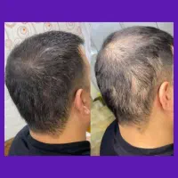 بازسازی پیشرفته ریشه
