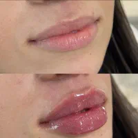 تخصص حرفه ای تزریق لب روسی|خدمات آرایشگری و زیبایی|ارومیه, |دیوار