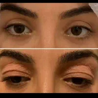 عمل رفع افتادگی پلک / رفع پف زیر چشم|خدمات آرایشگری و زیبایی|خمینی‌شهر, |دیوار