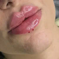 ژل فیلر بوتاکس
