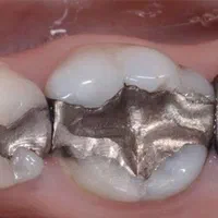 ضایعات آمالگام|آرایشی، بهداشتی، درمانی|تهران, زعفرانیه|دیوار