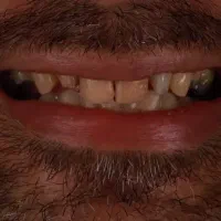 جشنواره تخفیفی دندانسازی
