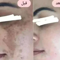 میخوای ۳روزه صورتت و بدنت سفید برفی شه ای کرم بزن|خدمات آرایشگری و زیبایی|ایذه, |دیوار