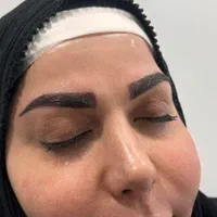 آف ویژه کاشت ابرو .مو.ریش در کلنیک کمیل