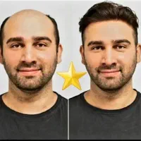 **کاشت مو حرفه ای طبیعی و پرتراکم بدون درد اقساط**