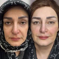 جشنواره تزریق ژل و لیفت صورت|خدمات آرایشگری و زیبایی|قم, زنبیل آباد|دیوار