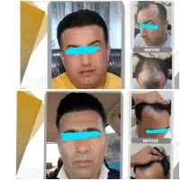 کاشت مو/ بلفاروپلاستی/بوکالفت/رفع غبغب/قسطی