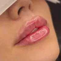 جشنواره ویژه یلدایی ژل،بوتاکس،پرسینگ