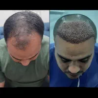 کاشت مو اقتصادی فقط ۲۰ تومن|خدمات زیبایی و سلامت|تهران, شهرک آزمایش|دیوار