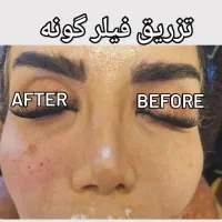 تزریق تخصصی ژل وبوتاکس دررشت