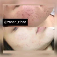 مزوتراپی مو و صورت و هیرفیلر (جشنواره)درمطب|خدمات آرایشگری و زیبایی|اصفهان, ملک‌شهر|دیوار