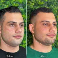 معماری صورت با فیلر/بوتاکس/پی ارپی/سلول های بنیادی|خدمات آرایشگری و زیبایی|تبریز, |دیوار