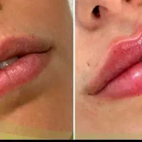 بوتاکس رایگان با انجام دو سی سی فیلر پیروزی|خدمات آرایشگری و زیبایی|تهران, چهارصد دستگاه|دیوار