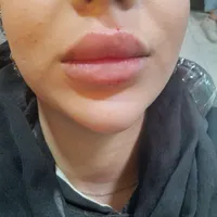 تزریق ژل وبوتاکس آنزیم مزوتراپی فیلربادی آموزش ژل