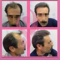کاشت مووابروبه بدون جراحی ودردوبصورت اقساطی|خدمات آرایشگری و زیبایی|تبریز, |دیوار