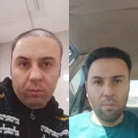کاشت مو بهبهان