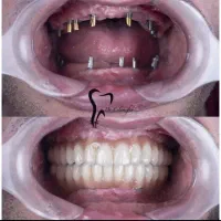 وام دندانپزشکی ایمپلنت|خدمات آرایشگری و زیبایی|رباط‌کریم, رباط‌کریم|دیوار