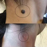 ژل وبوتاکس به روشmdپیرسینگ،فیشال،خال برداری