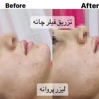 لیزر تخصصی موهای زائد.تزریق ژل فیلر...
