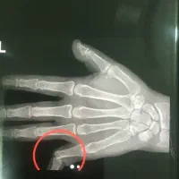 شکسته بندی ،رگ گیری  باتجربه بالا