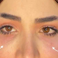 ژل بوتاکس چربی نخ|خدمات آرایشگری و زیبایی|ارومیه, |دیوار