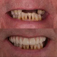 تعمیرات و ساخت دندان مصنوعی با قبول بیمه