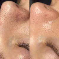 فشیال تخصصی+درماپلینگ+ اصلاح ابرو|خدمات آرایشگری و زیبایی|زاهدان, |دیوار