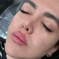 خدمات پرسینگ ژل بوتاکس