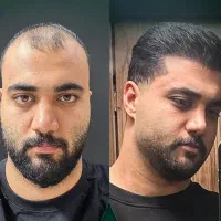 جشنواره کاشت مو پرتراکم تضمینی قیمت مناسب