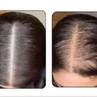 بیا کمکت کنم از شر ریزش و کم پشتی خلاص شی