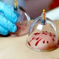 حجامت، فصد خون، تزریقات، بخیه|خدمات آرایشگری و زیبایی|اهر, |دیوار