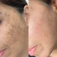 پاکسازی و جوانسازی پوست (فیشیال)|خدمات آرایشگری و زیبایی|تهران, مدائن|دیوار
