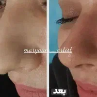 (کوچک کردن بینی فقط با1جلسه)1.500تومان50%تخفیف