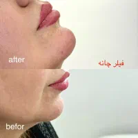 تزریق ژل، بوتاکس، مزوتراپی و جوانسازی پوست، هایفو