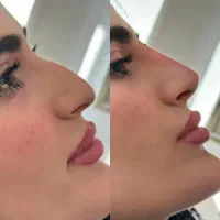 فیلر و بوتاکس پرسینگ چال لپ...|خدمات آرایشگری و زیبایی|قرچک, شهرک گلها|دیوار