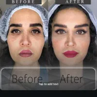 جوانسازی و لیفت بدون جراحی|خدمات آرایشگری و زیبایی|تهران, اختیاریه|دیوار