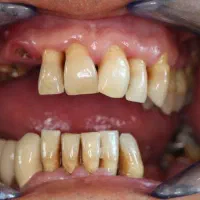 قسطی ایمپلنت و تمام خدمات دندانپزشکی بدون پیش|خدمات آرایشگری و زیبایی|اصفهان, دشتستان|دیوار